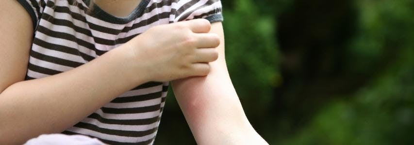 How to Get Rid of Mosquito Bites (Treating and Preventing Itchy Bites) guide cover image